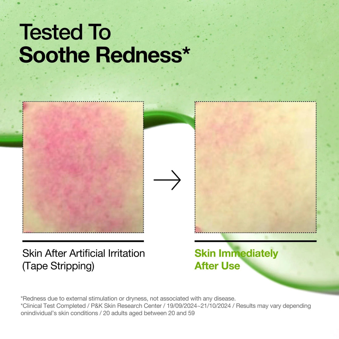 ANUA Azelaic Acid 10 Hyaluron Redness Soothing Serum (30 ML) ANUA